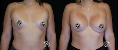 Breast Before & After Gallery - Patient 9630851 - Image 1