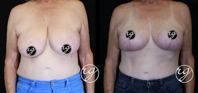 Breast Before & After Gallery - Patient 9630852 - Image 1