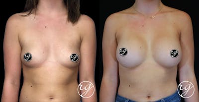 Breast Before & After Gallery - Patient 9630853 - Image 1