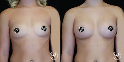 Breast Before & After Gallery - Patient 9630854 - Image 1