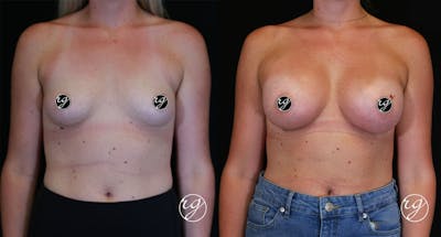 Breast Before & After Gallery - Patient 9630855 - Image 1