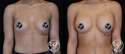 Breast Before & After Gallery - Patient 9630856 - Image 1