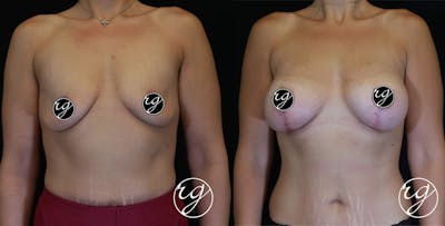 Breast Before & After Gallery - Patient 9630857 - Image 1