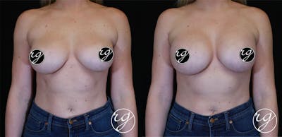 Breast Before & After Gallery - Patient 9630858 - Image 1