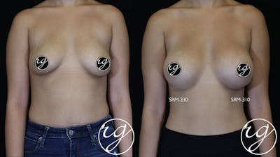 Breast Before & After Gallery - Patient 9630859 - Image 1