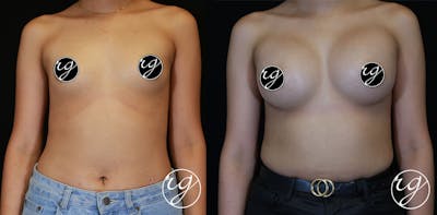 Breast Before & After Gallery - Patient 9630860 - Image 1