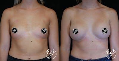 Breast Before & After Gallery - Patient 9630861 - Image 1