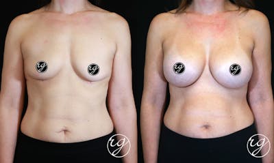 Breast Before & After Gallery - Patient 9630862 - Image 1