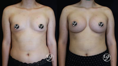 Breast Before & After Gallery - Patient 9630863 - Image 1