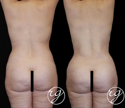 Body Before & After Gallery - Patient 9630866 - Image 1