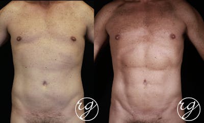 Body Before & After Gallery - Patient 9630867 - Image 1