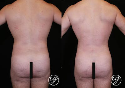 Body Before & After Gallery - Patient 9630868 - Image 1