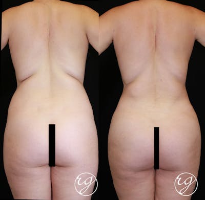 Body Before & After Gallery - Patient 9630869 - Image 1