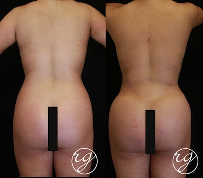 Body Before & After Gallery - Patient 9630871 - Image 1