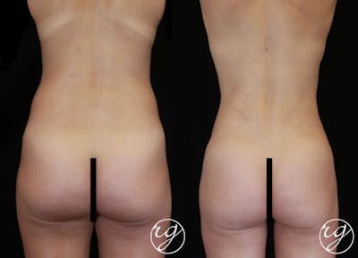 Body Before & After Gallery - Patient 9630872 - Image 1