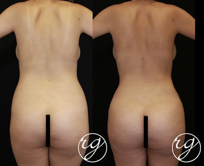 Body Before & After Gallery - Patient 9630873 - Image 1
