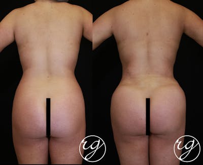 Body Before & After Gallery - Patient 9630875 - Image 1