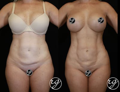Body Before & After Gallery - Patient 9630876 - Image 1