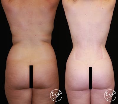 Body Before & After Gallery - Patient 9630877 - Image 1