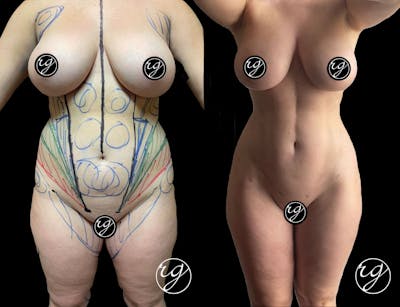 Body Before & After Gallery - Patient 9630878 - Image 1