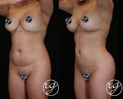 Body Before & After Gallery - Patient 9630879 - Image 1