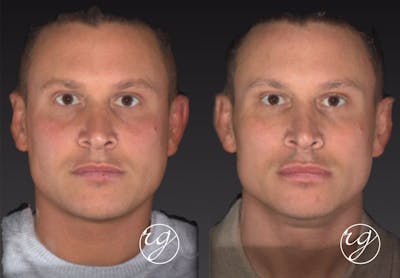 Face Before & After Gallery - Patient 9630895 - Image 1