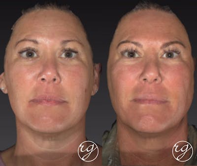 Face Before & After Gallery - Patient 9630896 - Image 1