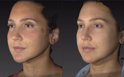 Face Before & After Gallery - Patient 9630894 - Image 1