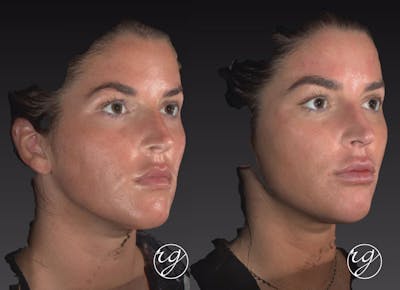 Face Before & After Gallery - Patient 9630898 - Image 1