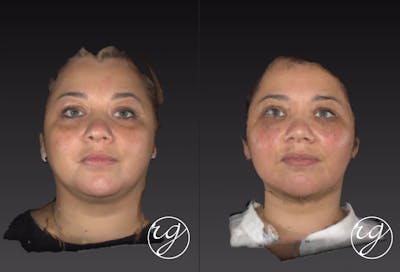 Face Before & After Gallery - Patient 9630905 - Image 1