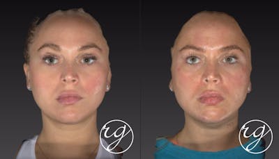 Face Before & After Gallery - Patient 9630906 - Image 1