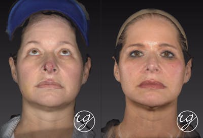 Face Before & After Gallery - Patient 9630908 - Image 1