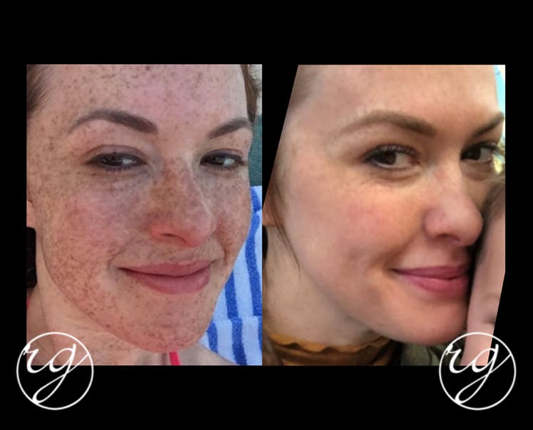 Bbl Light Treatment Before And After Shelly Lighting