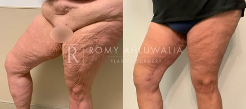 Before & After Result of Thigh Lift Patient #1