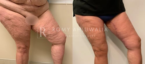 Before & After Result of Thigh Lift Patient #1