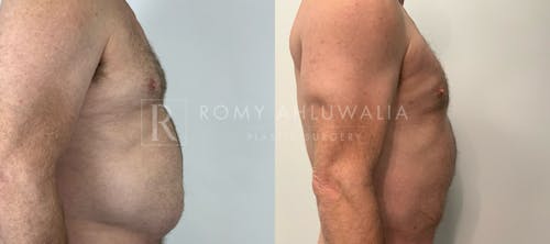 Before & After Result of Liposuction Patient #1