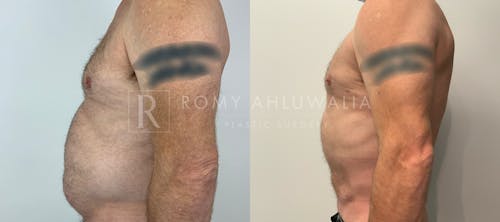 Before & After Result of Liposuction Patient #1