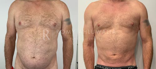 Before & After Result of Liposuction Patient #1