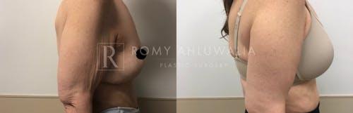 Before & After Result of Arm Lift Patient #1