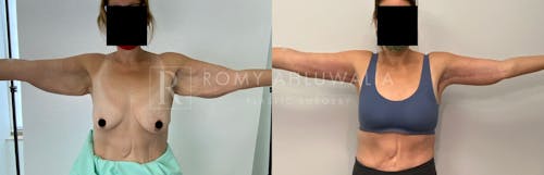 Before & After Result of Arm Lift Patient #2