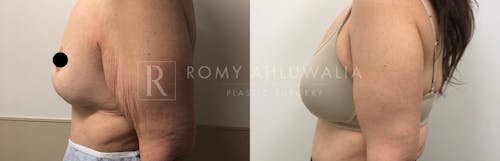 Before & After Result of Arm Lift Patient #1