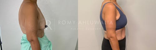 Before & After Result of Arm Lift Patient #2
