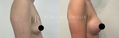 Before & After Result of Breast Augmentation Patient #16