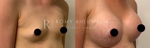 Before & After Result of Breast Augmentation Patient #18