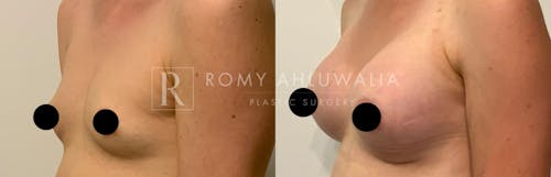 Before & After Result of Breast Augmentation Patient #18