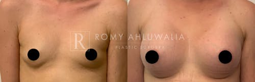 Before & After Result of Breast Augmentation Patient #18
