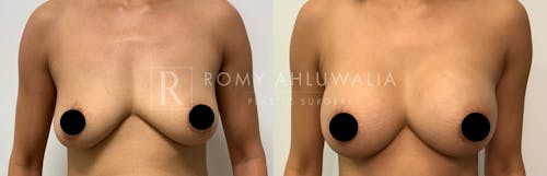 Before & After Result of Breast Augmentation Patient #17
