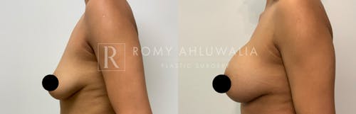 Before & After Result of Breast Augmentation Patient #17