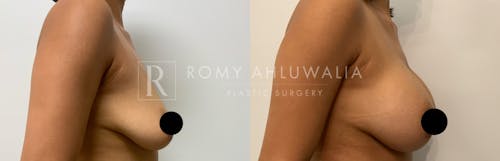 Before & After Result of Breast Augmentation Patient #17