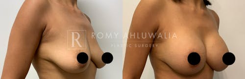 Before & After Result of Breast Augmentation Patient #17